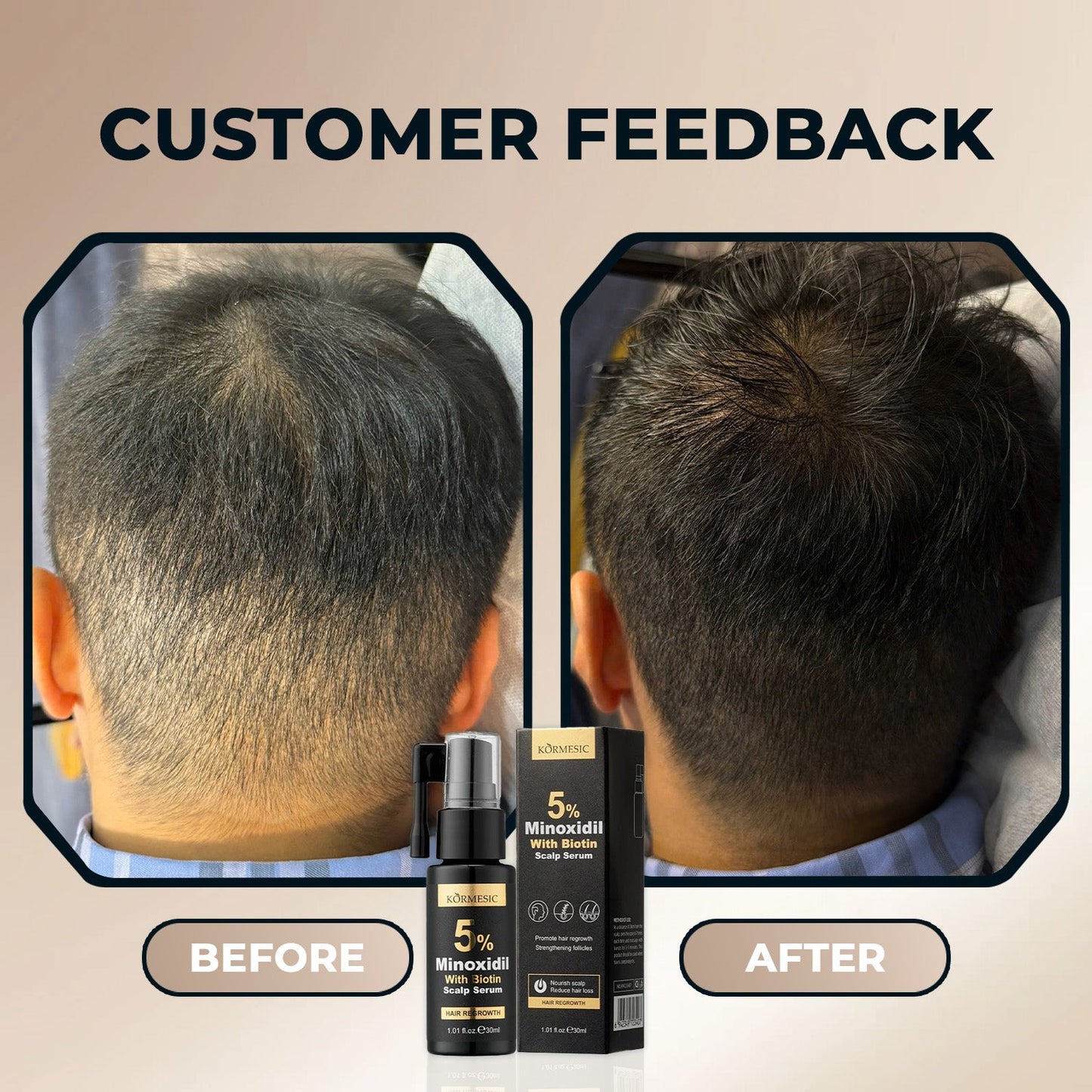 Kormesic Minoxidil with Biotin Scalp Serum 30 ml