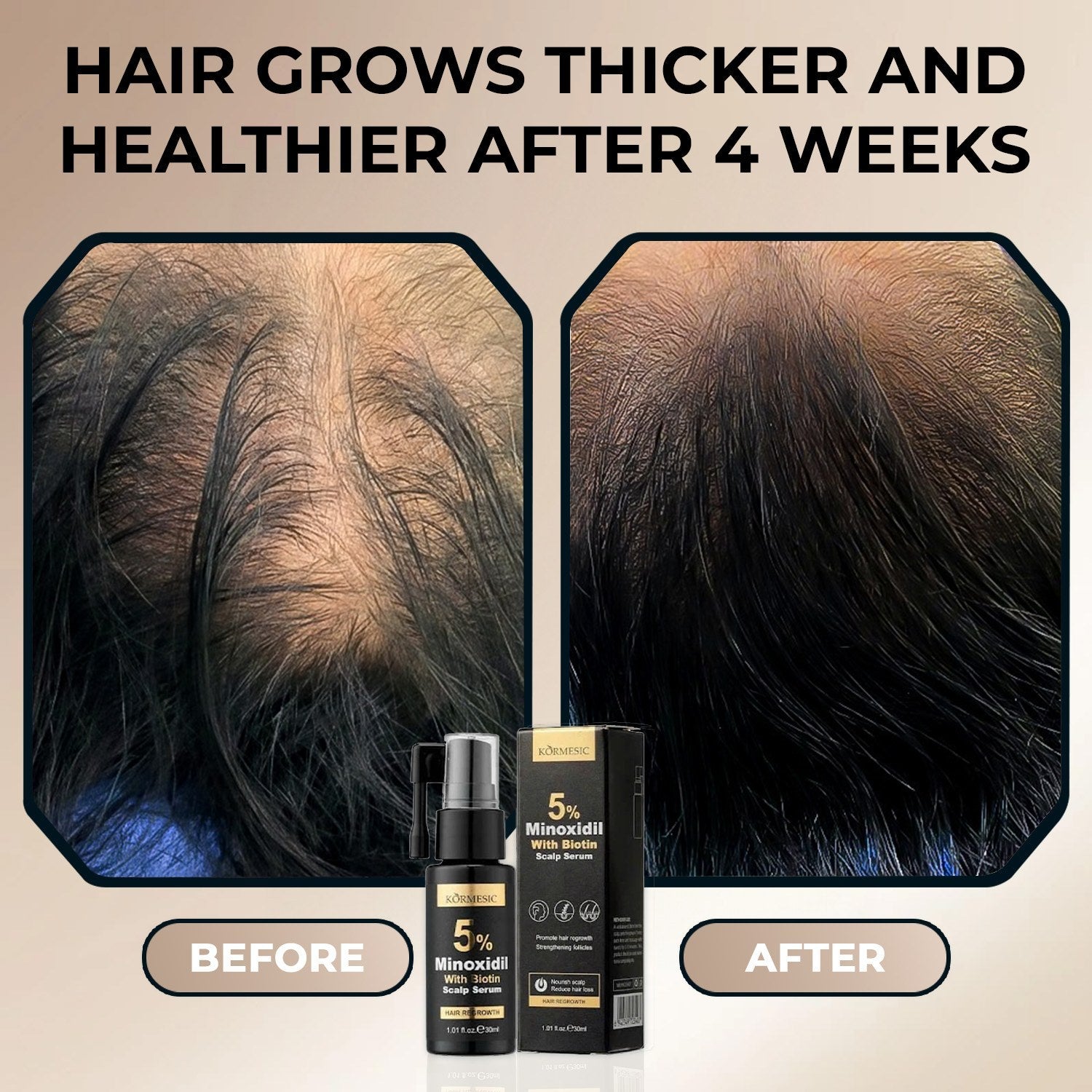 Kormesic Minoxidil with Biotin Scalp Serum 30 ml